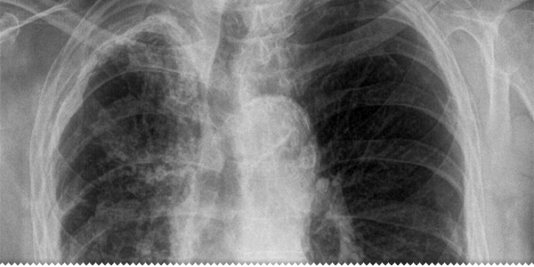 Opasnost od tuberkuloze u školama ljubuski.info